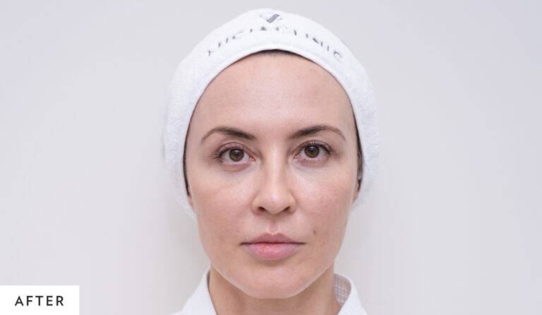 after_blepharoplasty_homepage