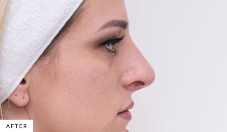 after_rhinoplasty_hp