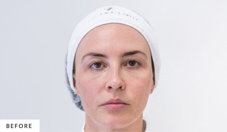 before_blepharoplasty_homepage