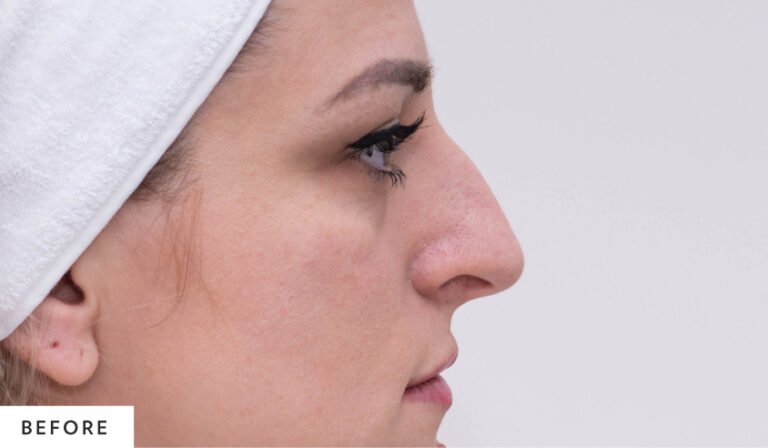 before_rhinoplasty_hp